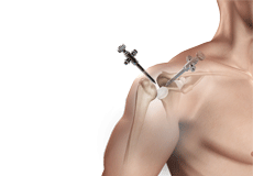 reconstructive shoulder surgery