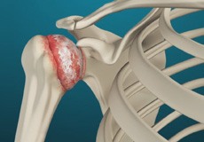 Shoulder Arthritis